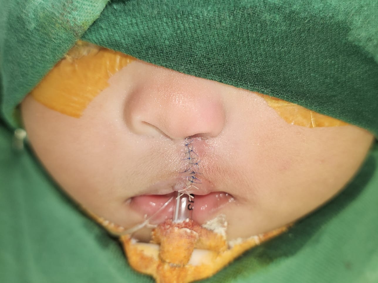Cleft Lip and Palate