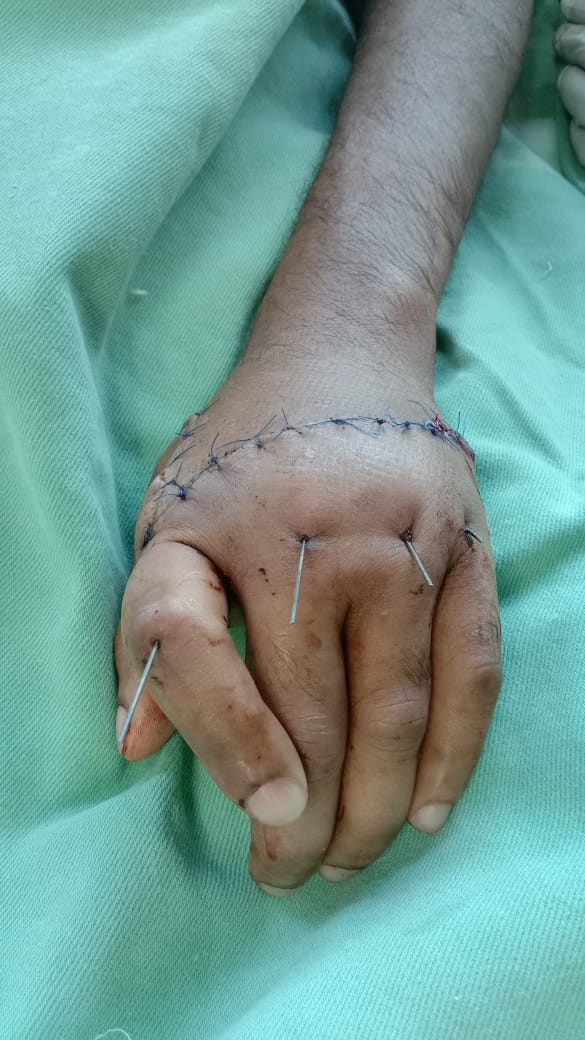Hand Surgery