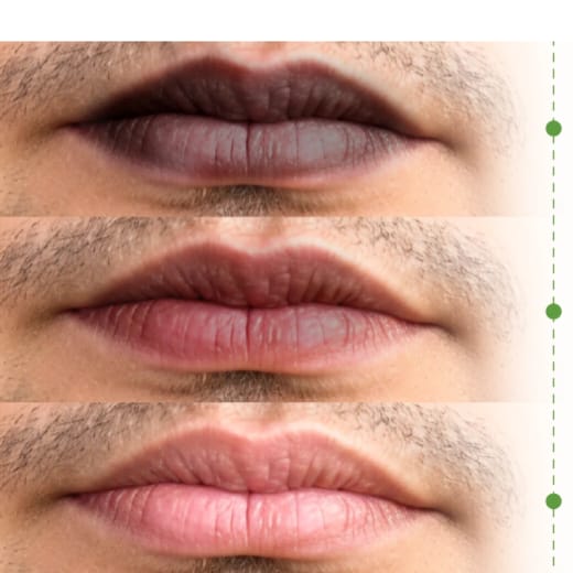 Lip Augmentation