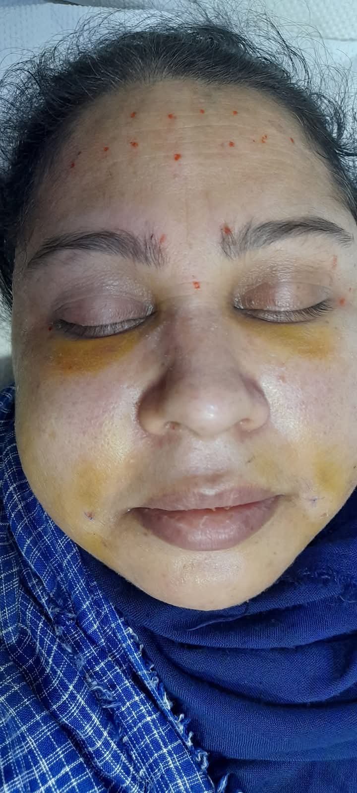 Non-Surgical Facial Rejuvenation