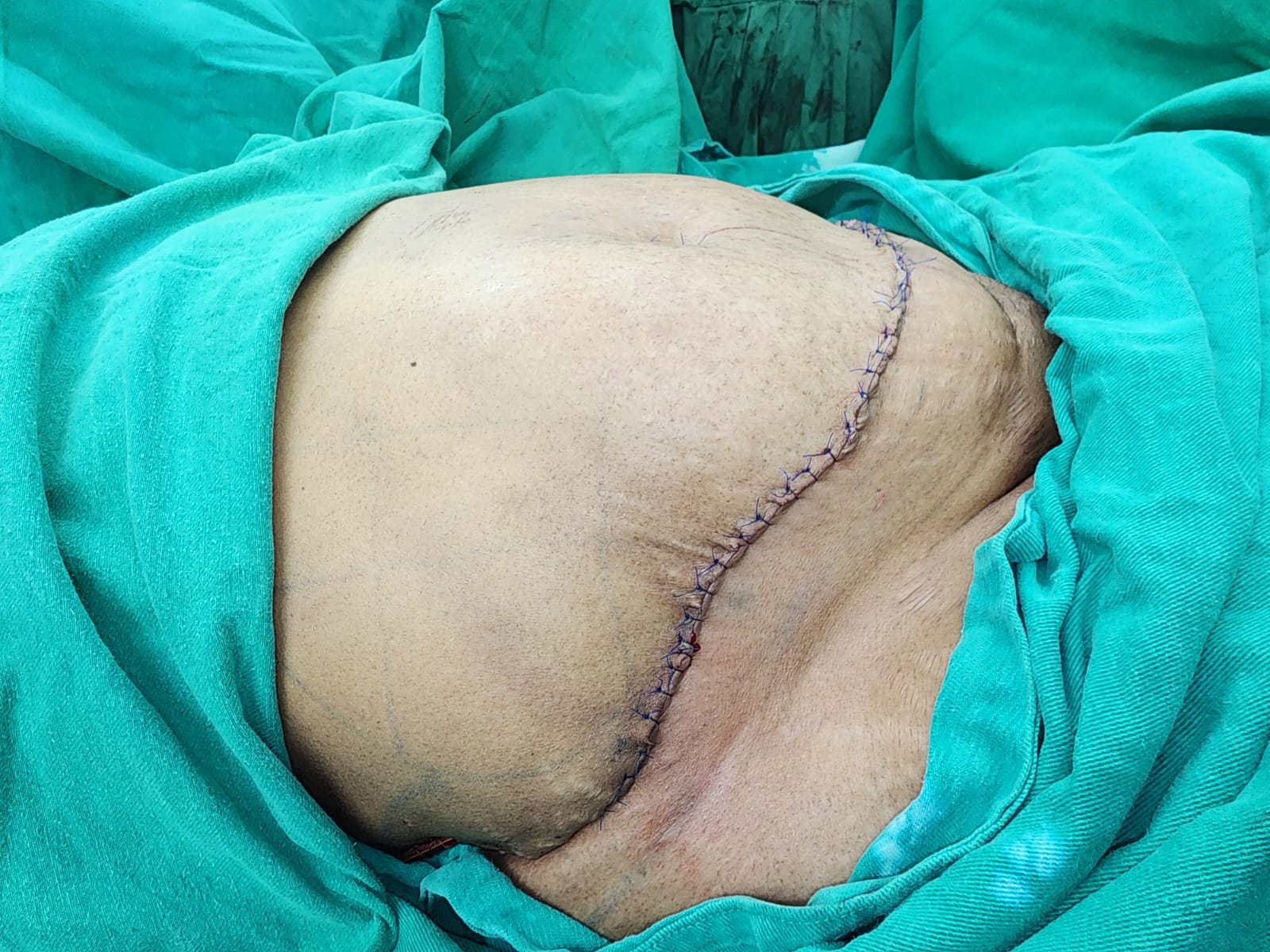 Post-Bariatric Body Contouring