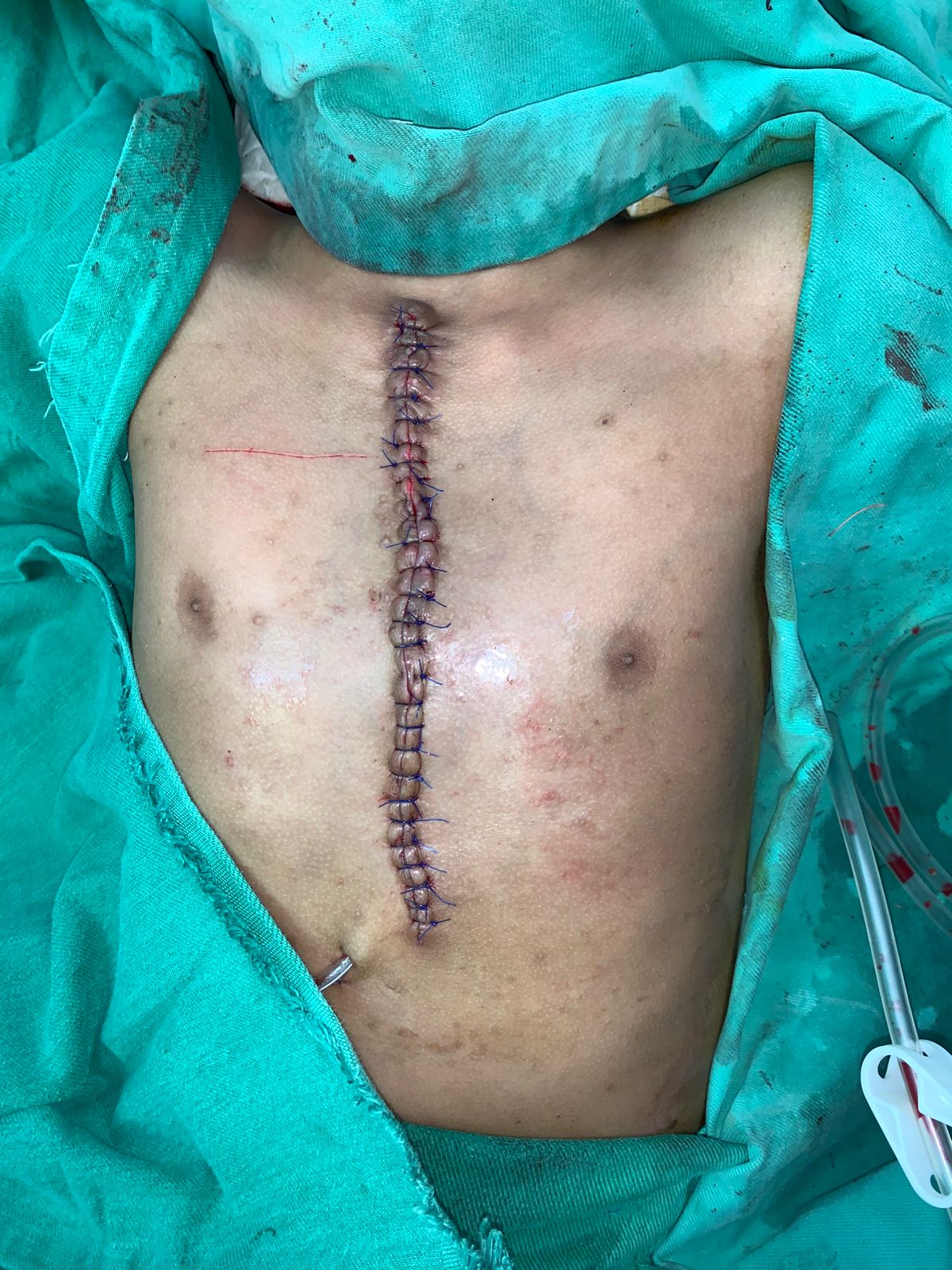 Anesthesia in Plastic Surgery