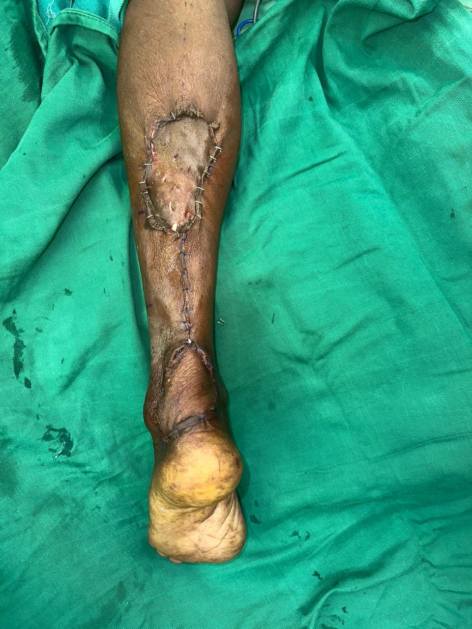 Trauma Reconstruction