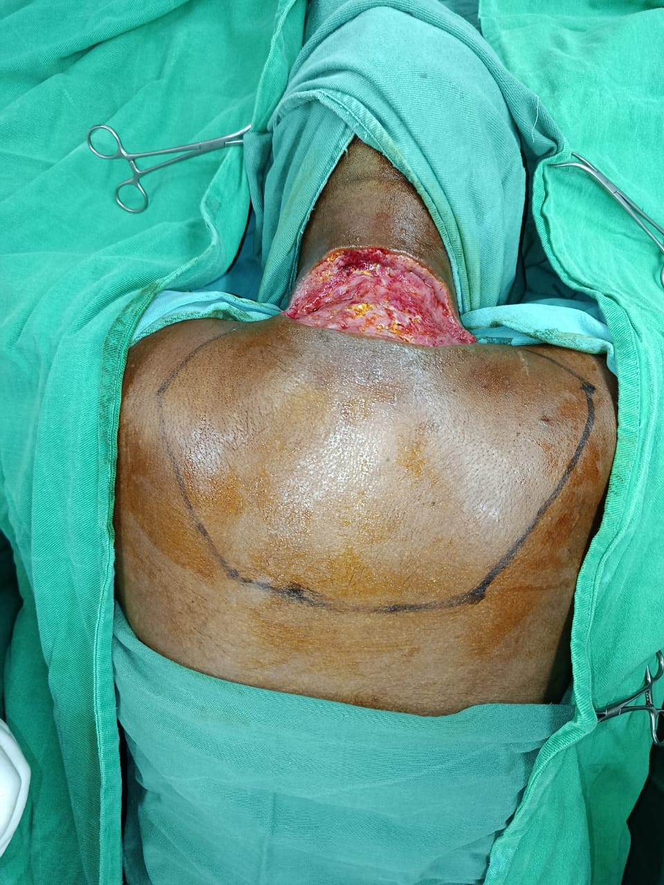 Skin Cancer Reconstruction