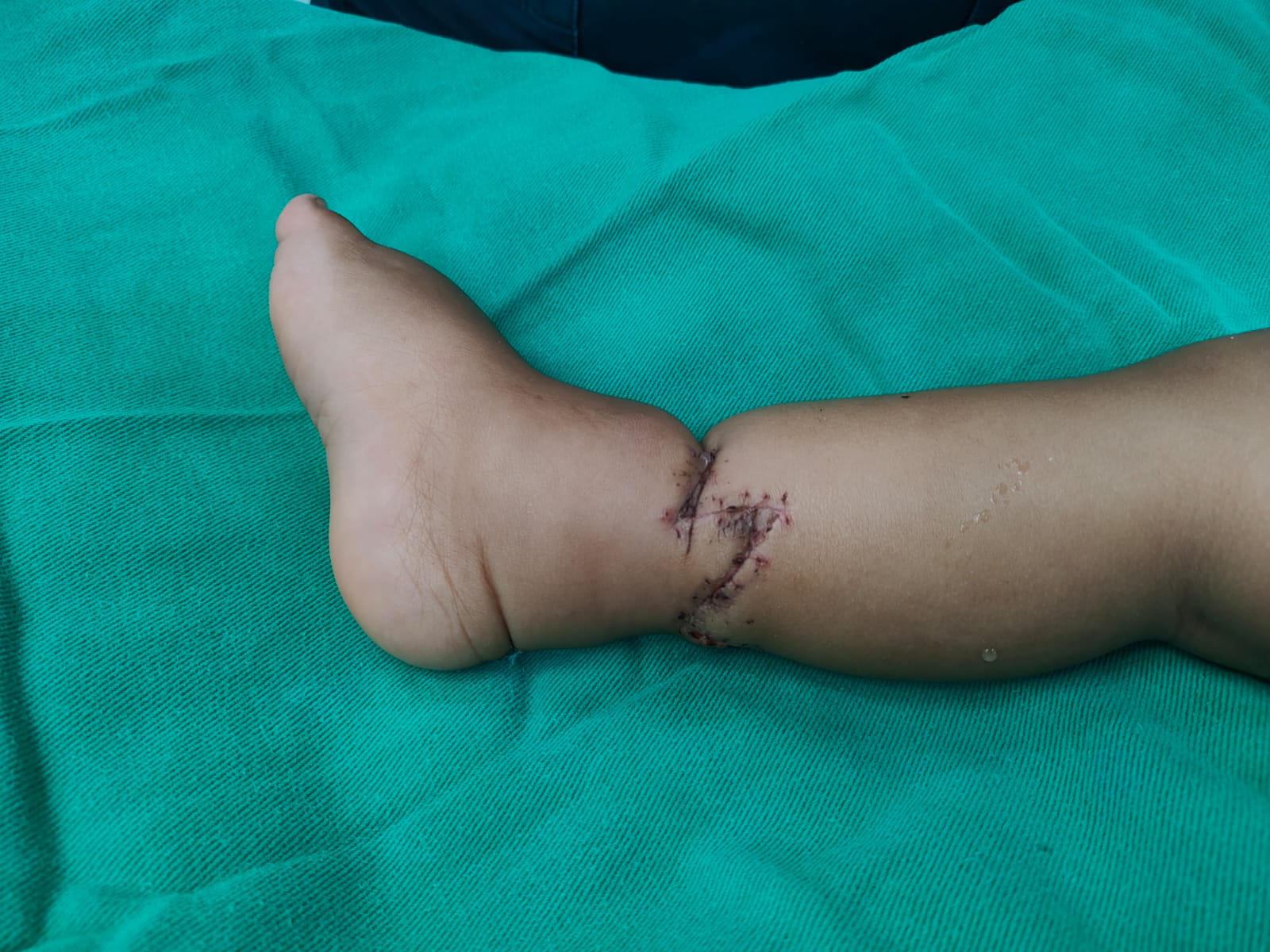 Burn Injuries Research